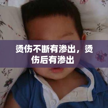 烫伤不断有渗出，烫伤后有渗出 